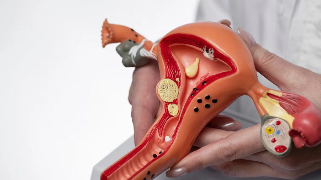 ovarian cysts